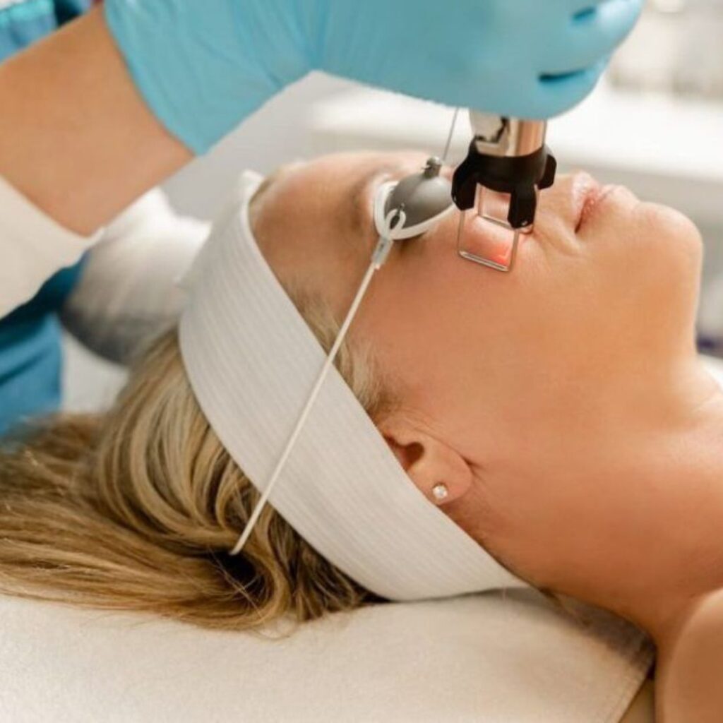 CoolPeel Laser Treatment