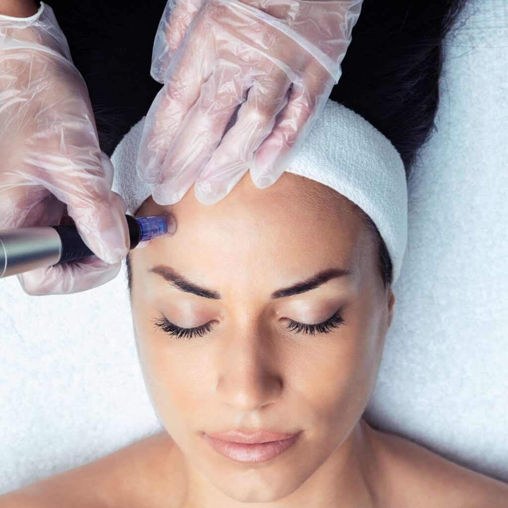 Microneedling Treatment