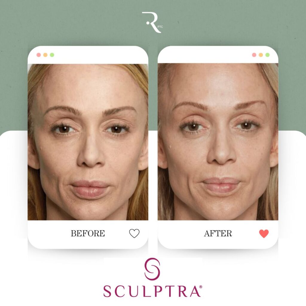 Sculptra Before and After